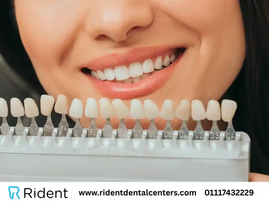 درجات تبييض الأسنان – دليلك لمعرفة درجات تبييض الأسنان